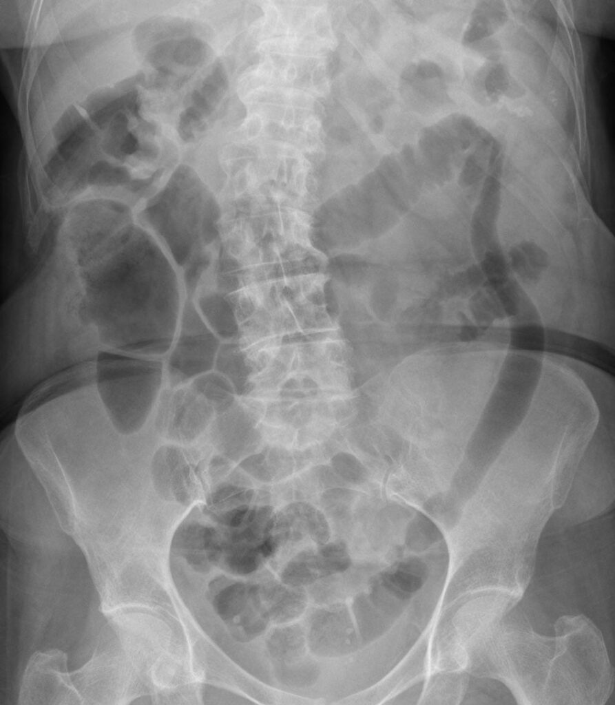 Cómo gestionar los síntomas de colitis ulcerosa durante el clima variable de Medellín.