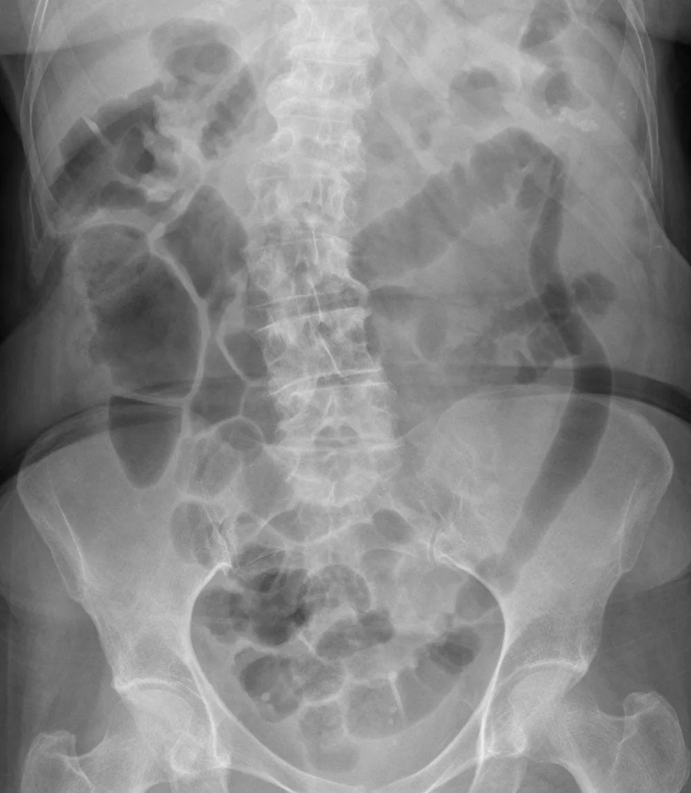 Recomendaciones para el manejo de la colitis ulcerosa en la ciudad