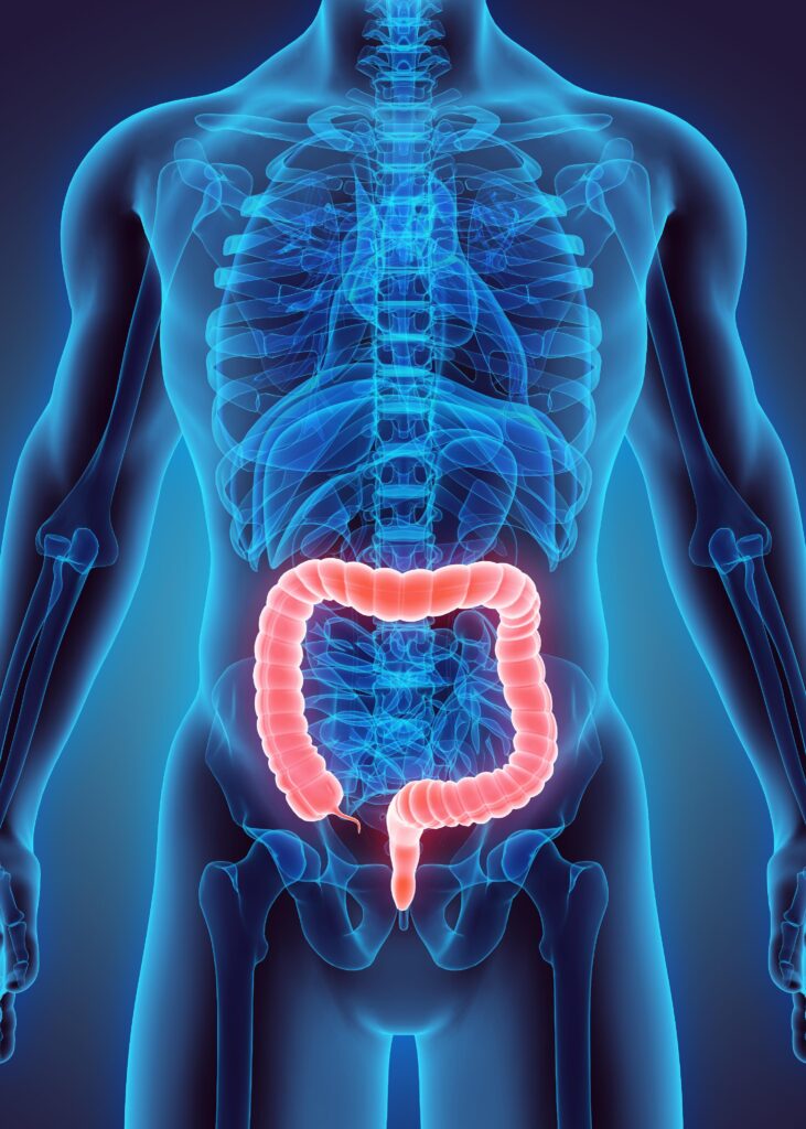 Datos sobre el rol de la dieta antiinflamatoria en el tratamiento de la colitis ulcerosa en Medellín.