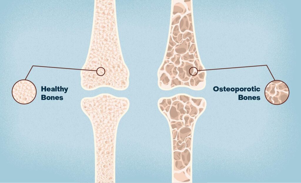 Cómo prevenir la osteoporosis con ejercicios recomendados por médicos