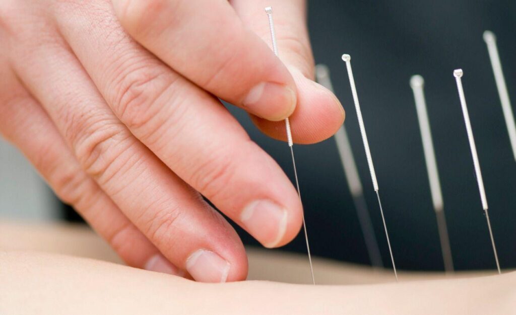 Beneficios de la acupuntura según los médicos en el Hogar Geriátrico Sonríe a la Vida