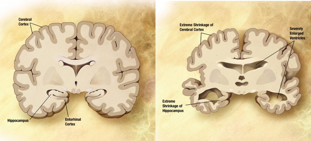 La verdad oculta detrás de los mitos sobre el tratamiento del Alzheimer en adultos mayores