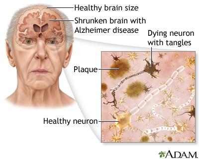 Recomendaciones para Cuidadores de Pacientes con Alzheimer