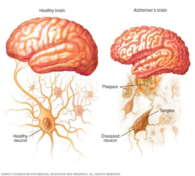 La Importancia de la Detección Temprana en el Alzheimer