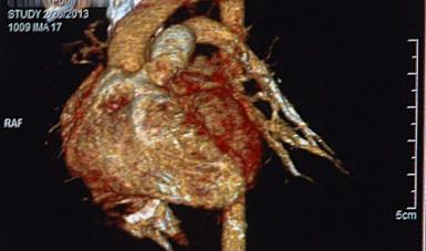 Introducción al Síndrome del corazón partido en cuidadores